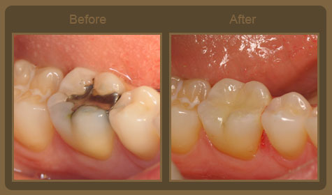 Family Dentist | Teeth Cleaning | Crowns | Childrens Dentist | Dentistry | St Joseph | Berrien County | Southwest Michigan